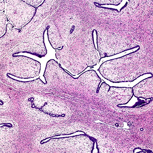 filoides, tumor benigno de la mama